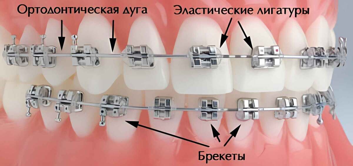 Основные элементы брекет-системы