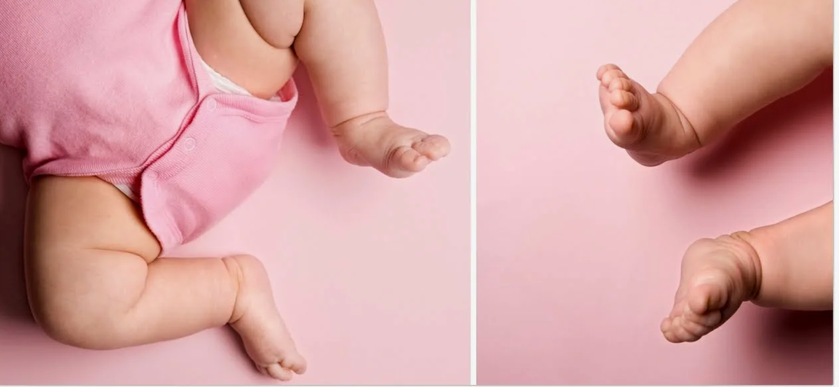 Дисплазия тазобедренного сустава (ДТБС) 