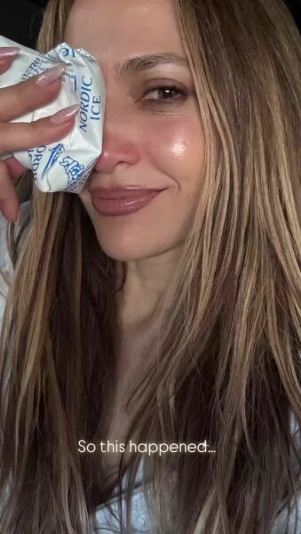    Джей Ло разбили нос. Фото: