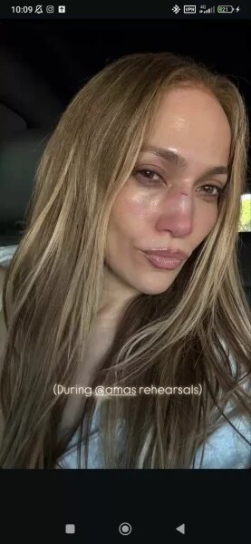    Джей Ло разбили нос. Фото: