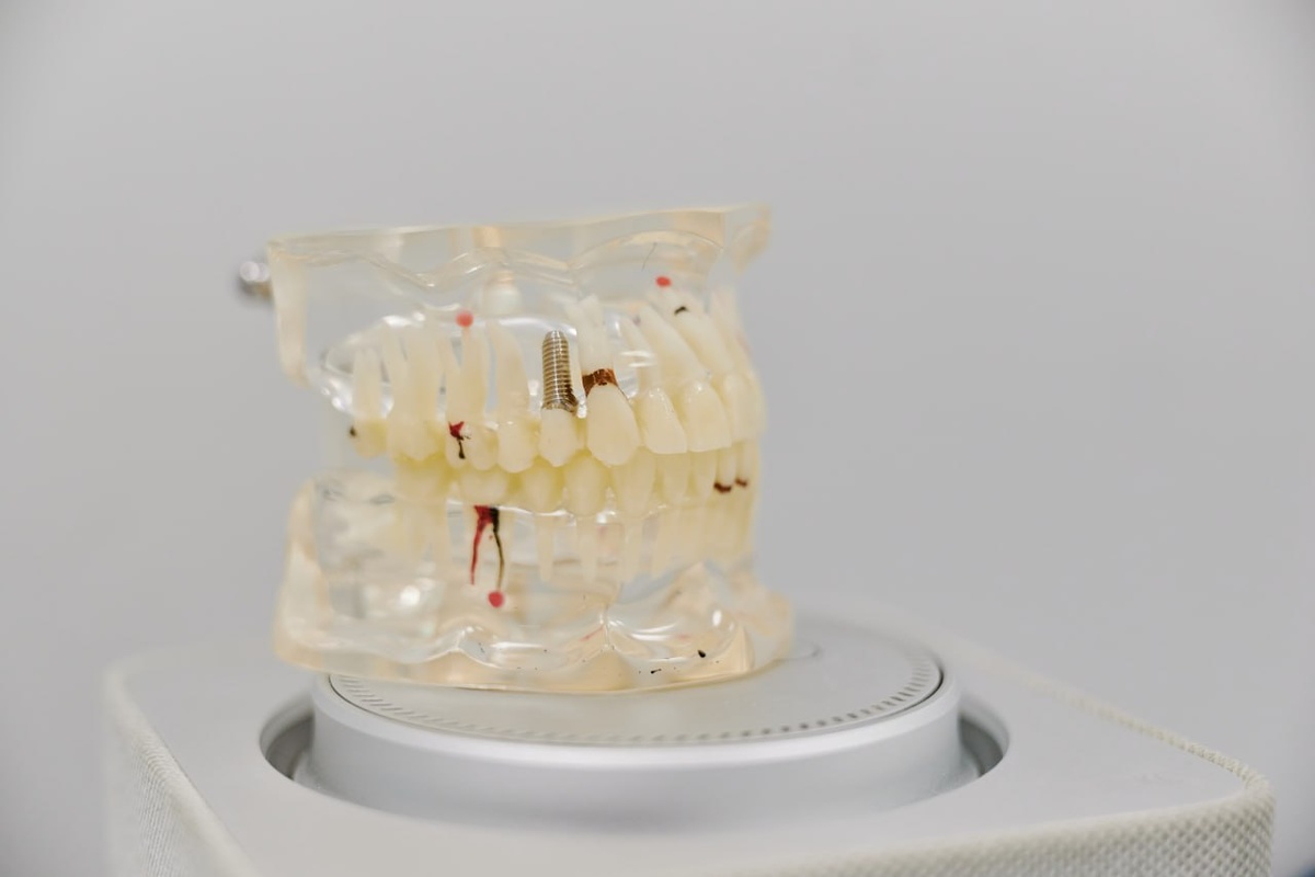 Имплантация — самая эффективная и безопасная замена отсутствующего зуба.