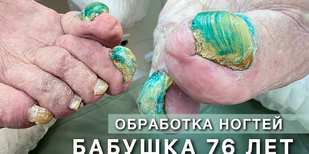 Онихогрифоз у пожилых