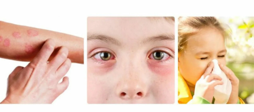 Аллергия 