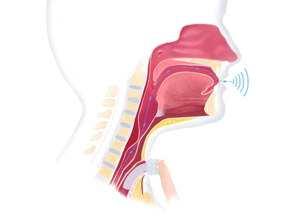 Пищеводная речь посредством глотания воздуха
