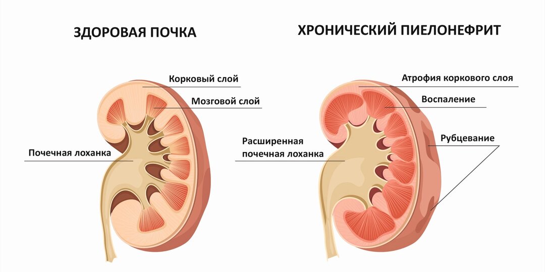 Первые симптомы Пиелонефрита у женщин и мужчин