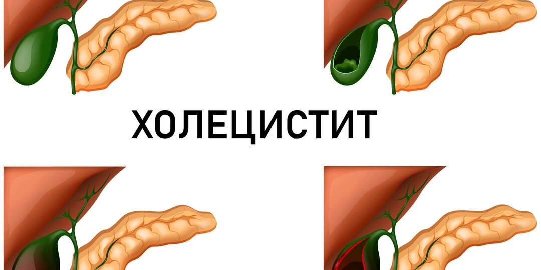 Первые симптомы Холецистита. Острый и хронический холецистит