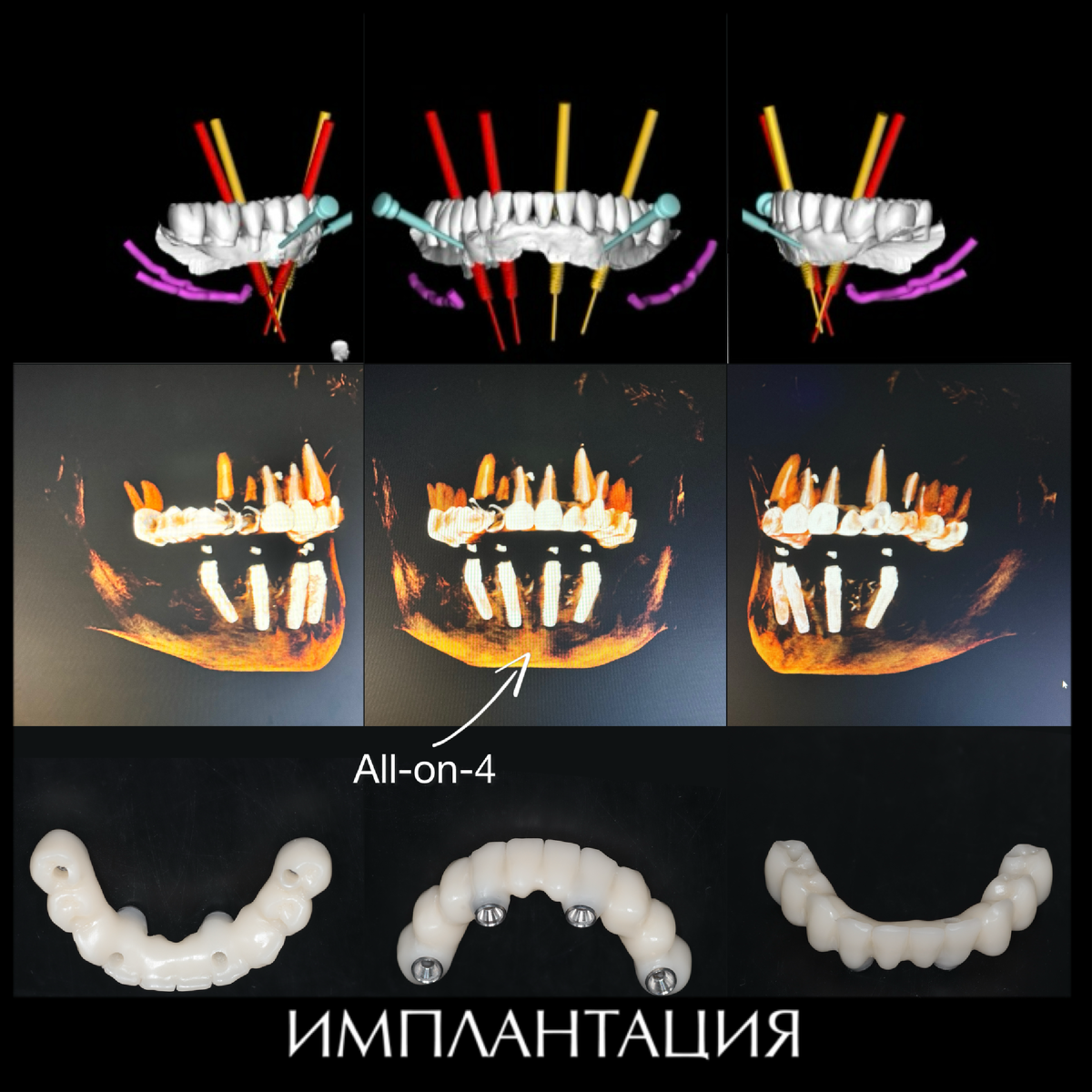 Тотальная реабилитация пациента (нижняя челюсть)