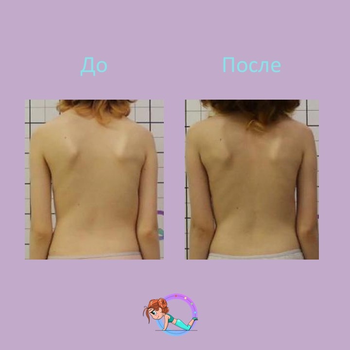 
Пациентка П. 2010 г.р. обратилась на приём к врачу ортопеду к.м.н. 👨🏻‍⚕️ Громову И.С. с жалобами на деформацию позвоночника
При осмотре поставлен диагноз: юношеский идиопатический 
сколиоз 2 степени (Тест Риссера: 3)
✅Было пройдено лечение: корсетотерапия по методу Шено 
На сегодняшний момент в корсете Шено угол деформации уменьшен с ⚡️23 до 5⚡️ градусов 👏🏼
❗️Коррекция в корсете 80%❗️
Так же получен хороший косметический результат 👍🏼

