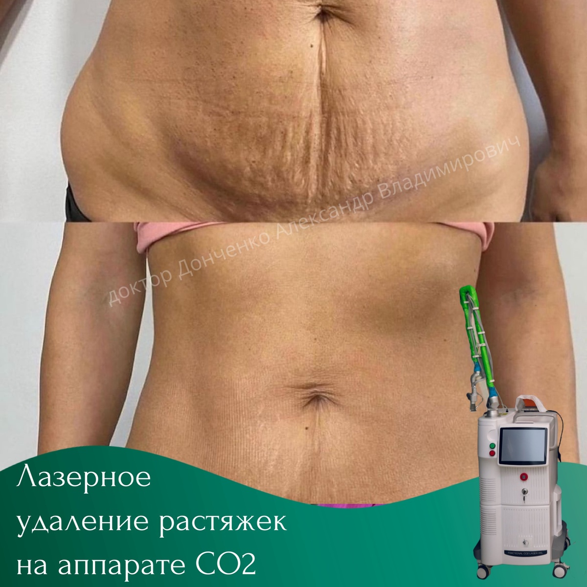 Лазерное удаление растяжен на аппарате CO2