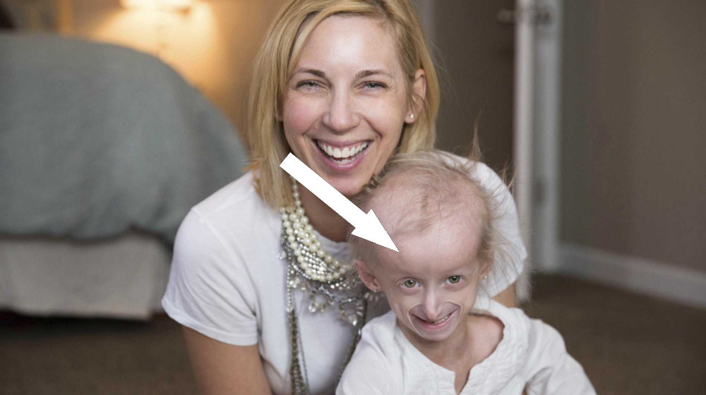    Дети, которые стареют за год как за десятилетие Болезнь Хатчинсона и прорывы генной терапии в 2025