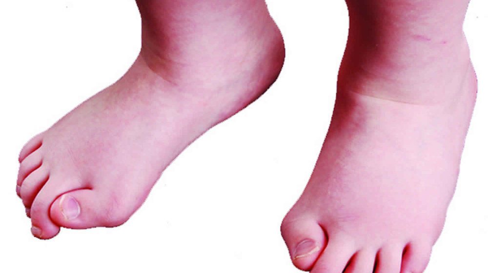    Болезнь каменного человека превращает жизнь в кошмар и наука пока бессильна