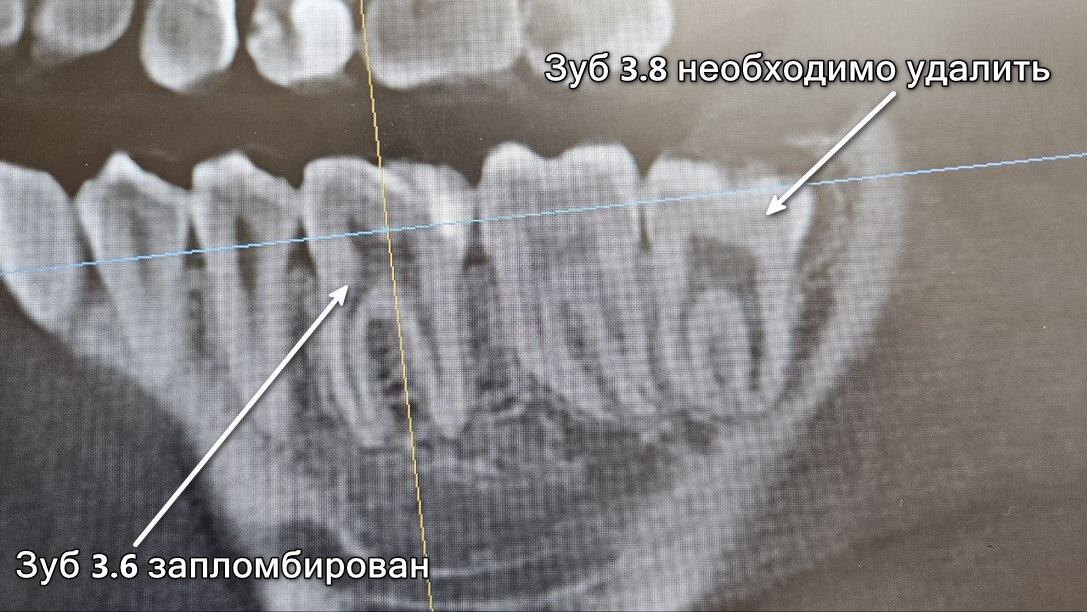 Снимок до удаления зуба 3.8