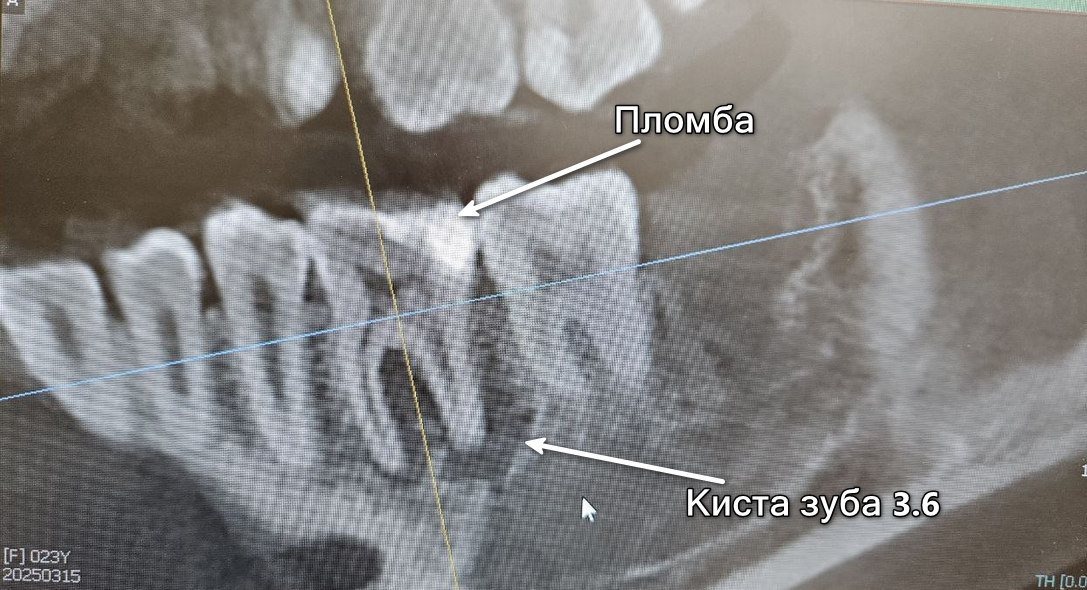 Снимок через 30 дней после удаления зуба 3.8