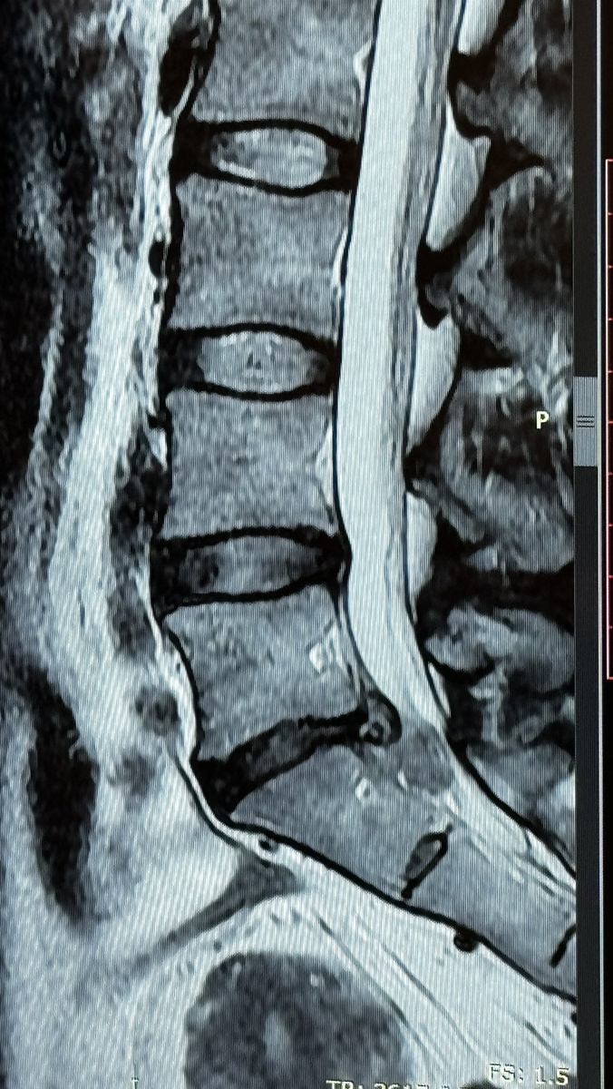 Темная лужица под грыжей, это ее содержимое