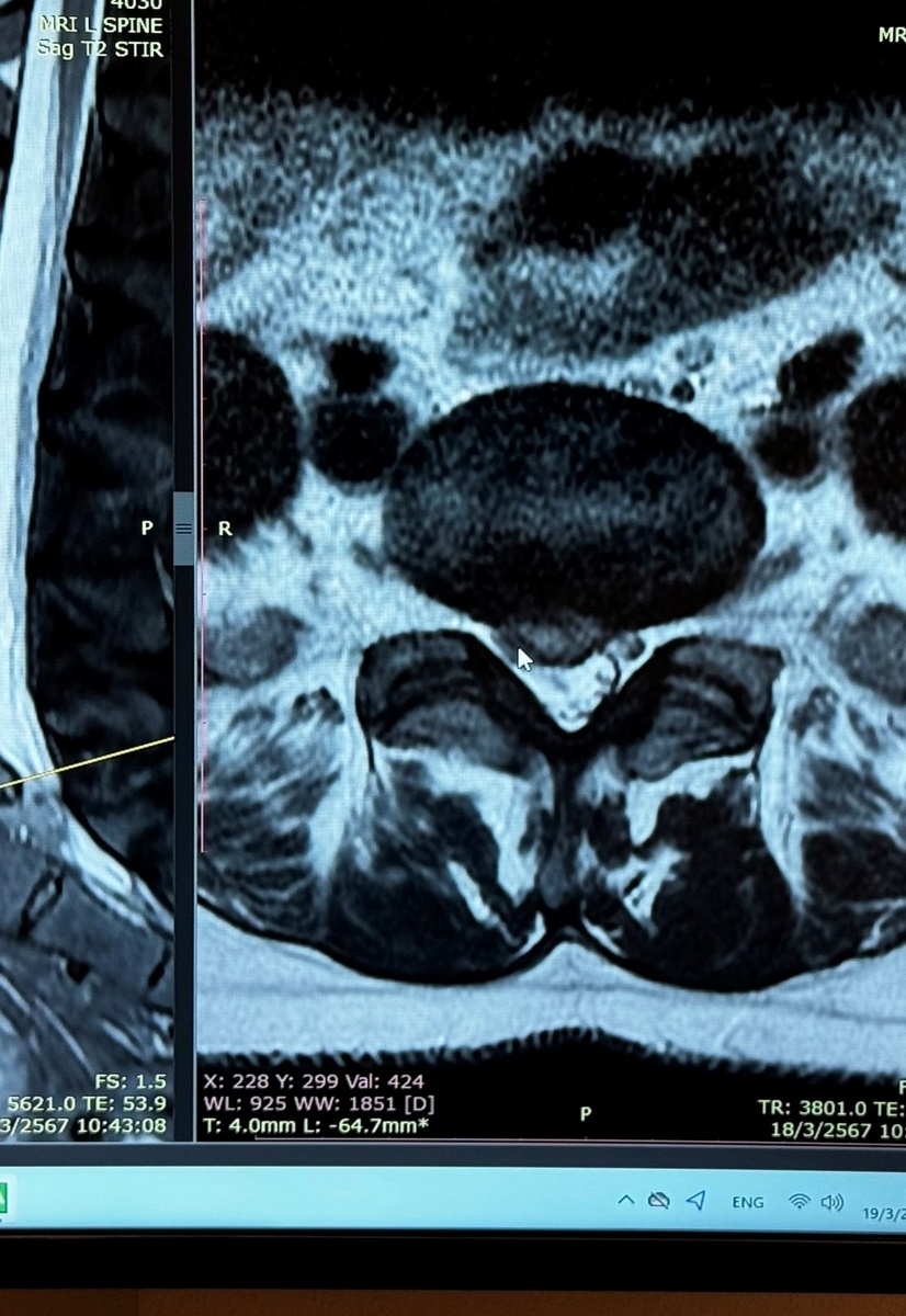 А здесь видно сужение канала