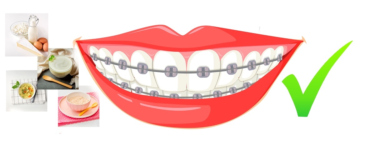 Правильный рацион сохранит брекеты и зубы