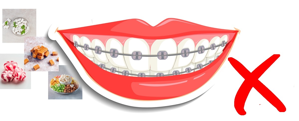 Нежелательные продукты при лечении брекетами
