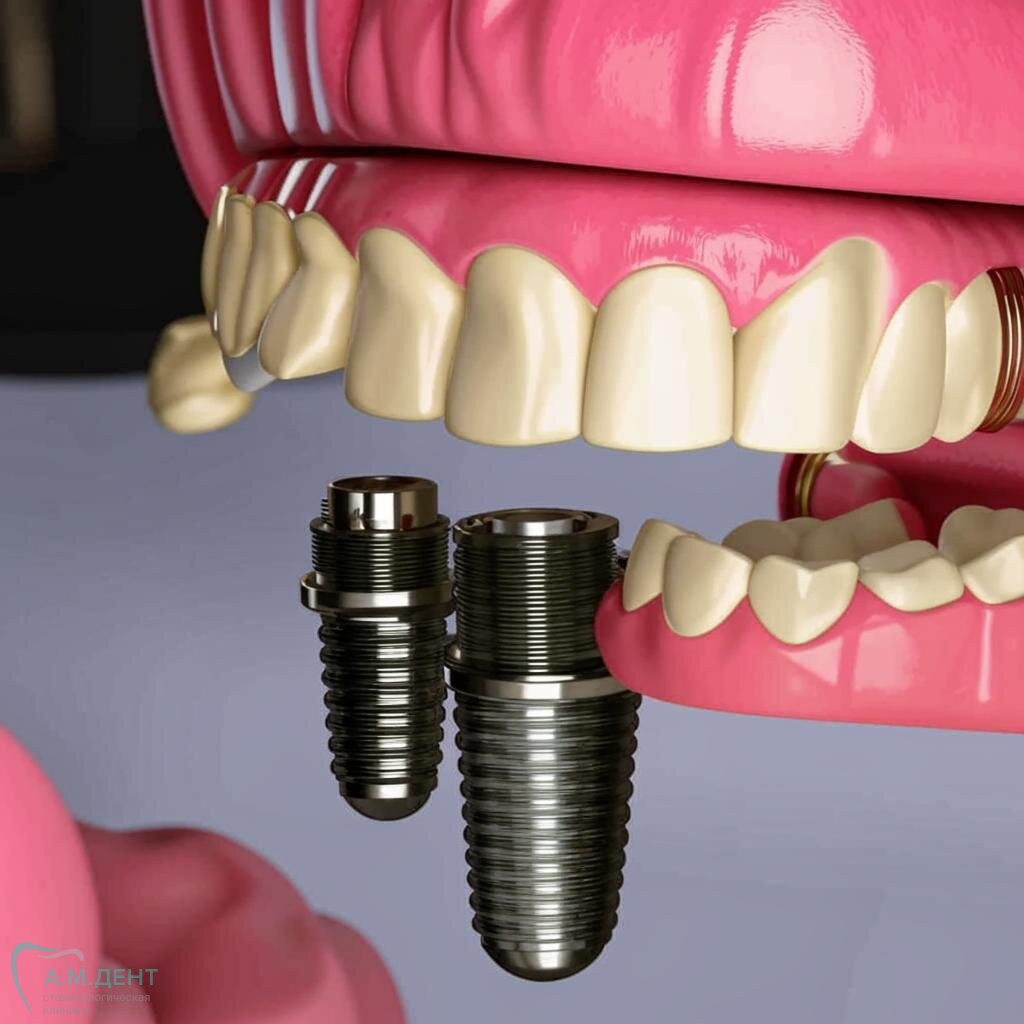 Удаление зуба было давно — теперь уже поздно?