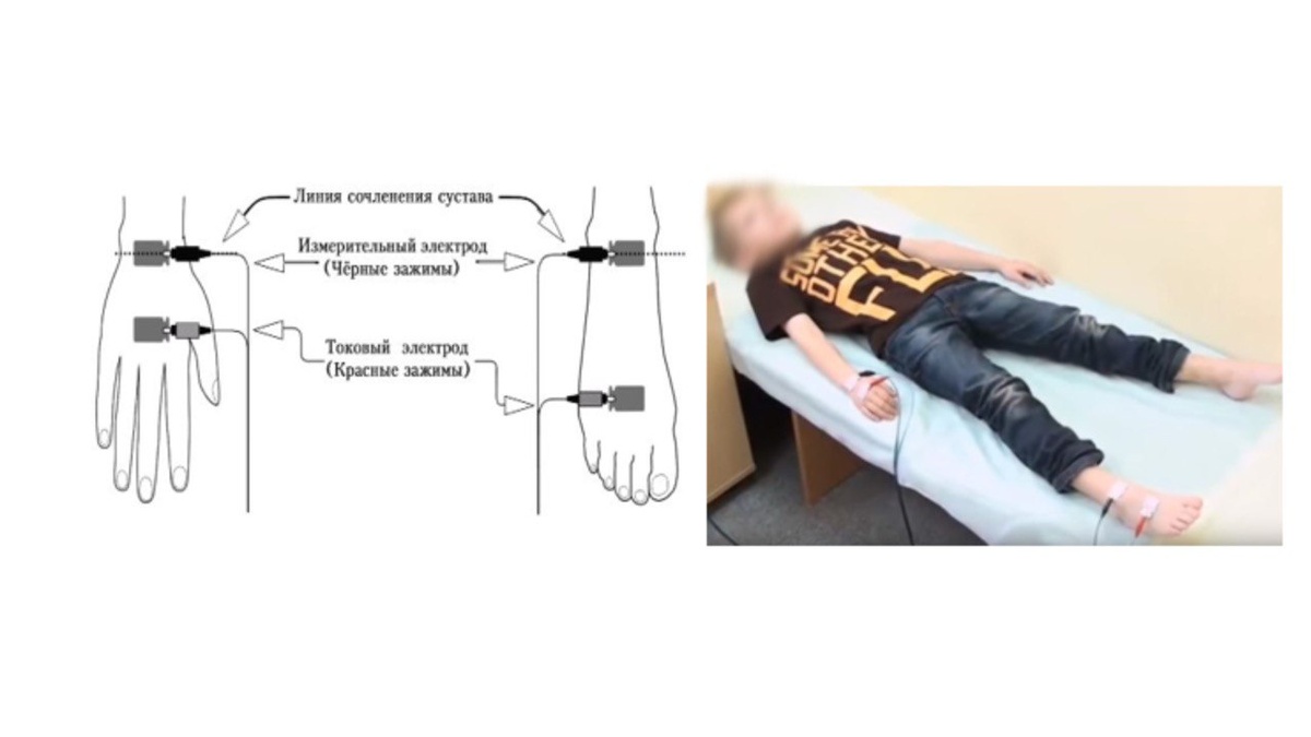 Как проходит процедура биоимпедансного анализа

Перед началом я записываю в программу основные данные пациента: возраст, пол, рост, вес, а также обхват талии и бёдер. Это важно, чтобы аппарат рассчитал всё максимально точно.

Затем к телу прикрепляются специальные электроды — на правую руку и ногу.

Электроды ставятся в определённые точки — так, чтобы они считывали сигнал правильно: не просто на кожу, а строго по линиям, где заканчивается кисть и начинается предплечье, или где стопа переходит в голень.

Есть два типа электродов — одни «читают» сигнал, другие «подают» ток. Их ставят недалеко друг от друга — с разницей всего в 2–3 см.

Если мы проводим исследование ребёнку младше 9 лет — то электрод на руку берётся маленький, половинчатый, чтобы подходил по размеру.