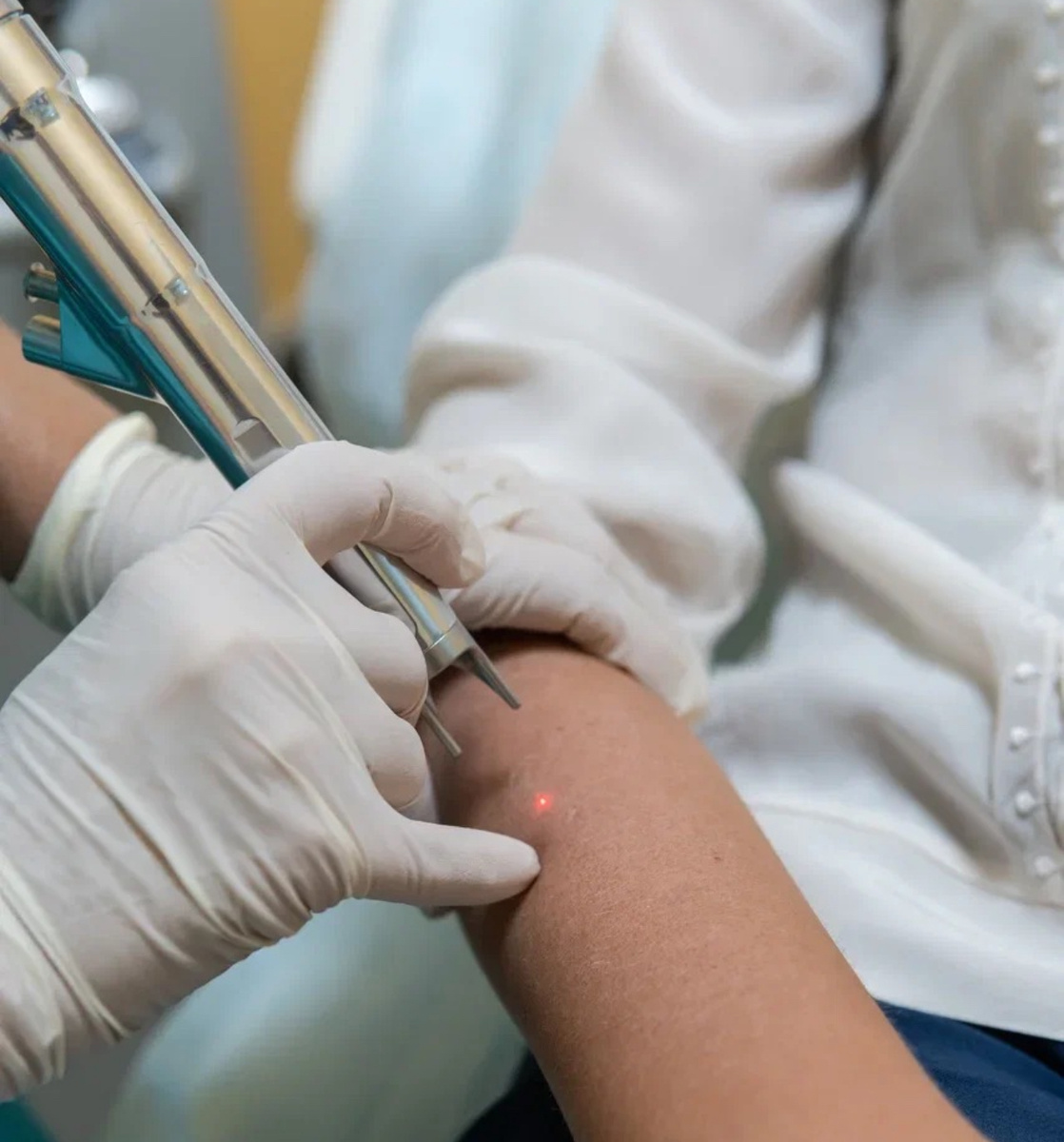 Лазерное удаление родинок в Екатеринбурге 