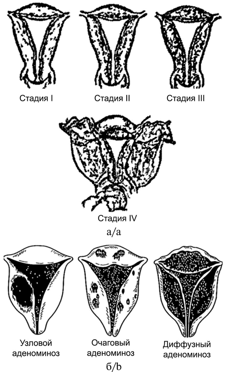 Рисунок 1. Стадии и формы аденомиоза
