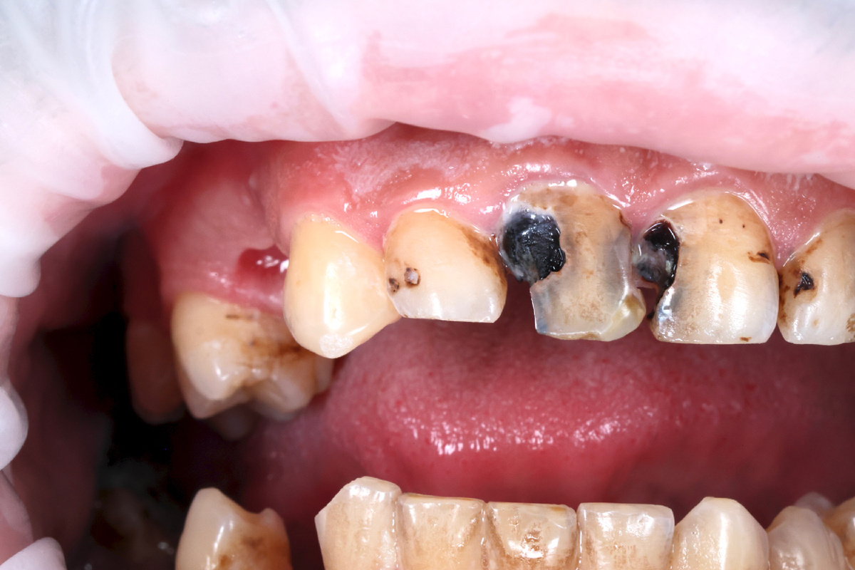 Состояние зубов до лечения