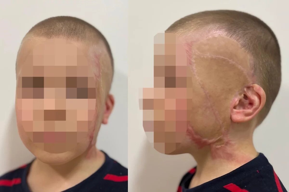    Тимофей из Оренбургской области после операции.