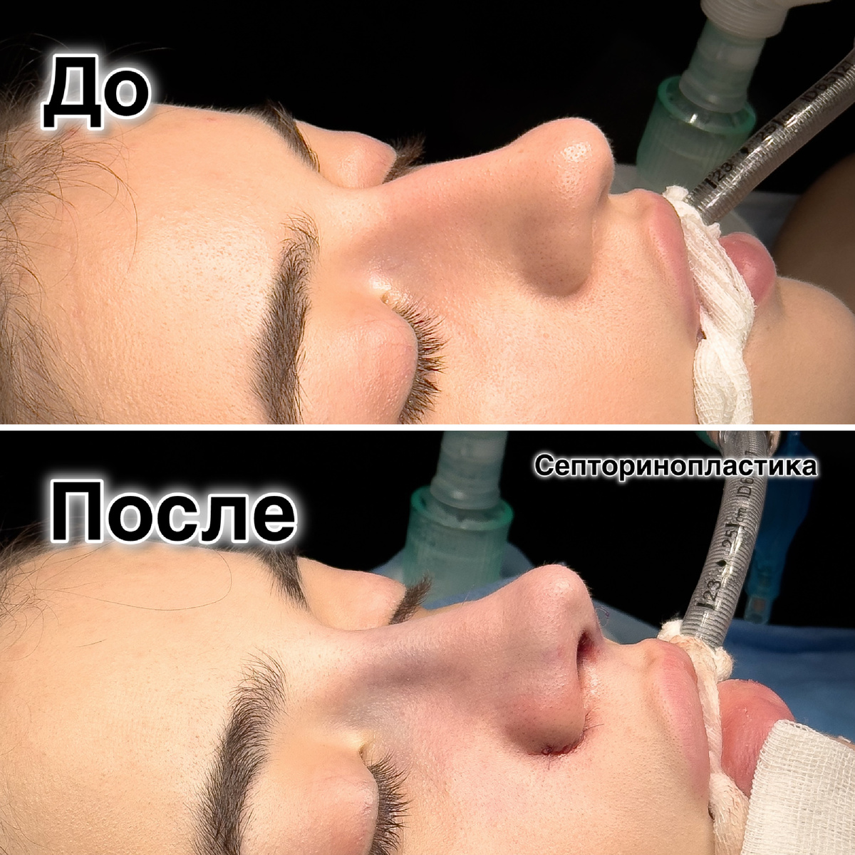 Пластическая операция - закрытая ринопластика, хирург Стайсупов В.Ю.