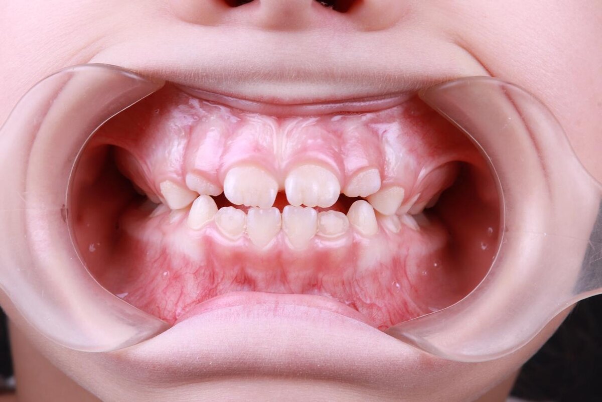 Юный пациент ПРАЙМа с сужением верхнего зубного ряда.