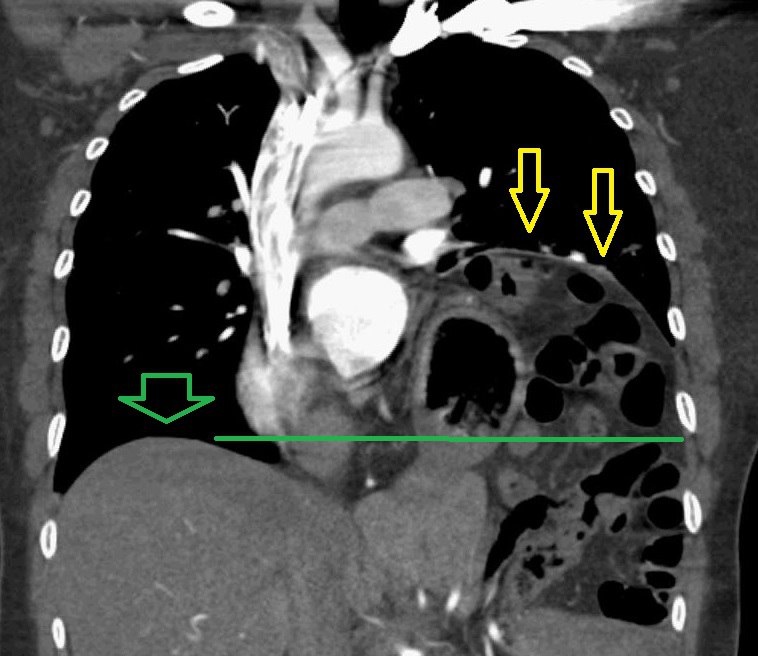 Желтые стрелки подъем левого купола диафрагмы, зеленая и линия это нормальный уровень правого купола