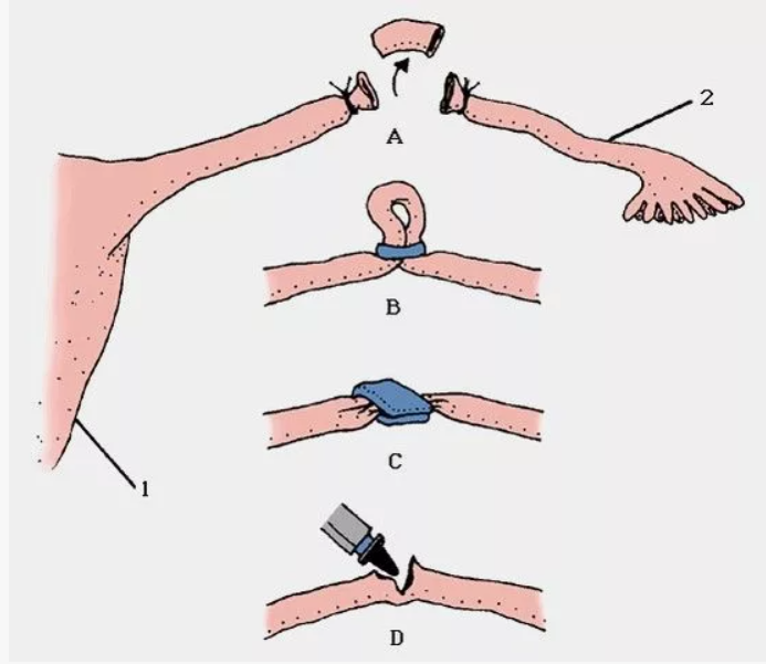Виды перевязки наглядно. Pinterest