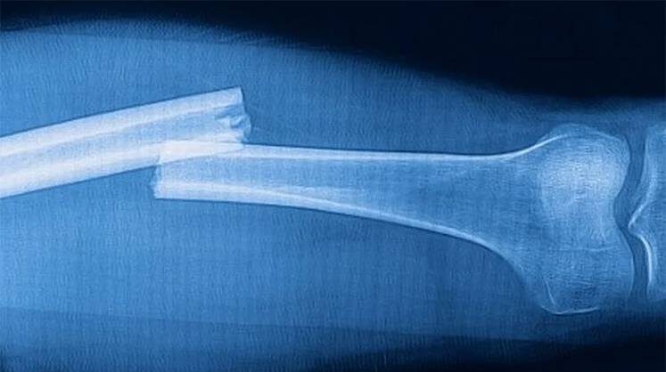     Отечественных имплантатов хватит на всех