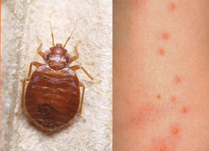 Укусы клопа