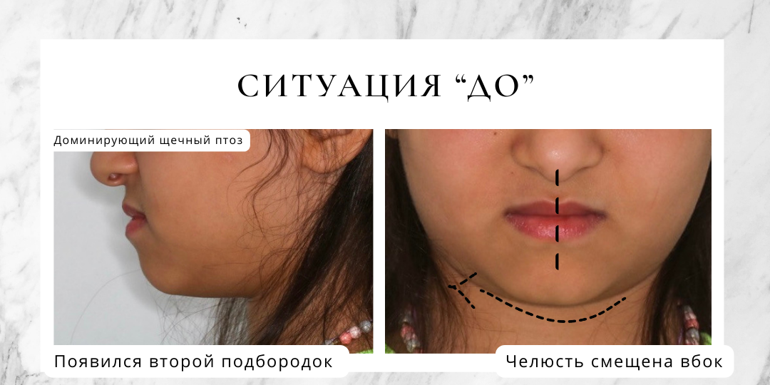 Серьезная патология прикуса у ребенка