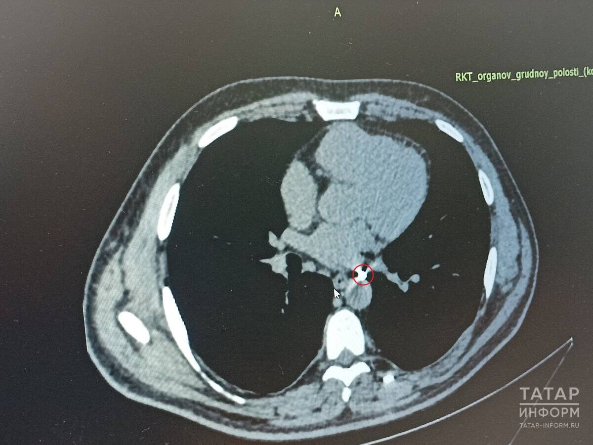 Неделю назад хирурги РКБ Татарстана удалили самый опасный осколок из тела ВладимираФото: © Роман Баданов / «Татар-информ»