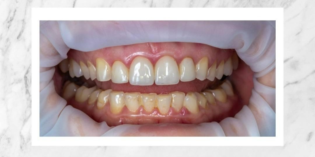 Этим винирам 20 лет!