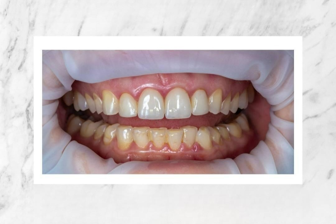 Этим винирам 20 лет!