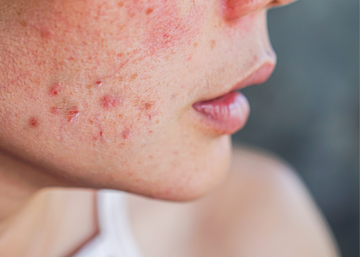 Нужно сделать несколько правильных шагов и стереть угри и прыщи с вашего лица