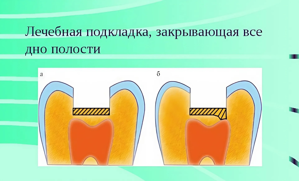 Лечебная прокладка при пломбировании зуба