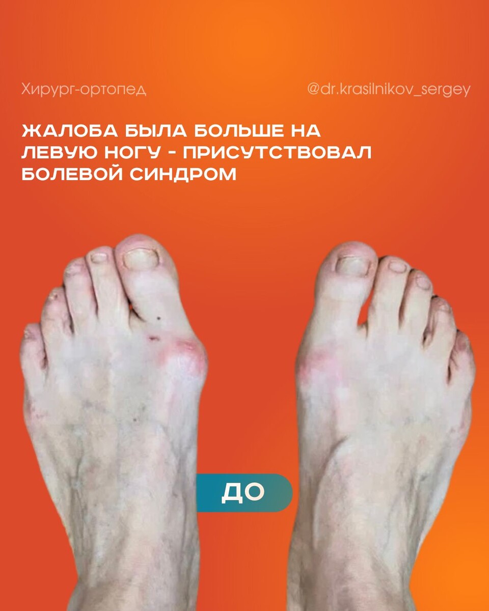 Фото стоп ДО операции