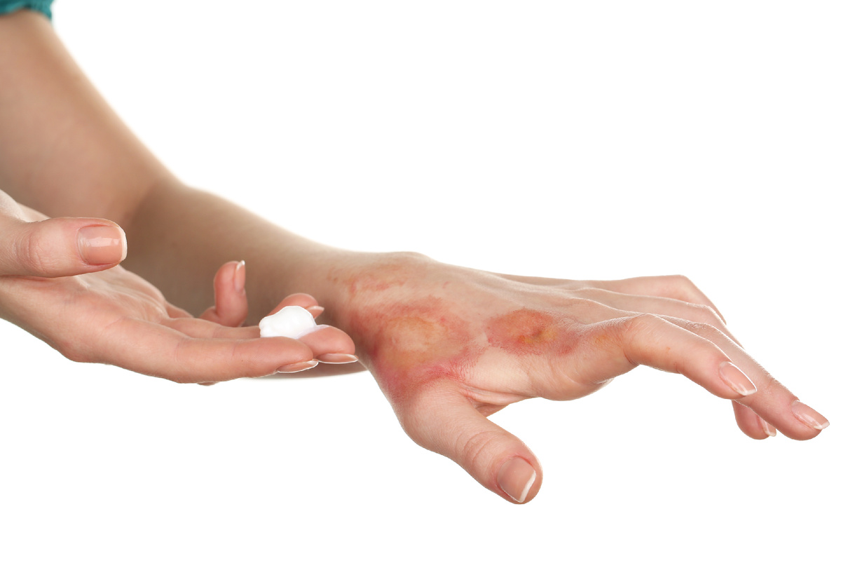 Что делать при ожогах? Первая помощь в домашних условиях (источник изображения: freepik.com)