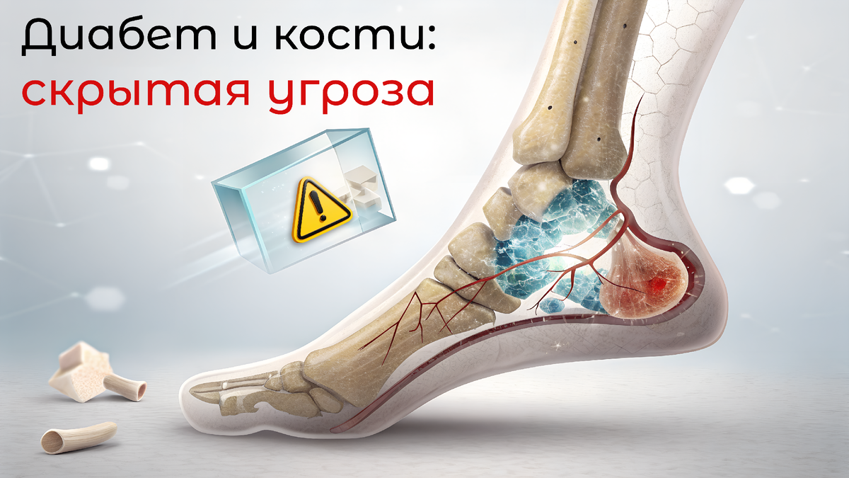 Перелом на ровном месте после 45? 😱 Вините не только возраст, но и… Диабет! Скрытая угроза хрупких костей