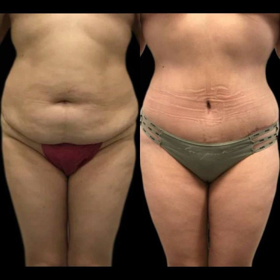 Выполнили полную абдоминопластику и липосакцию живота и боков
