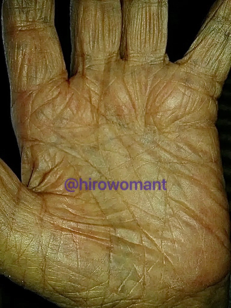 Рука мужчины-долгожителя, 105 лет.