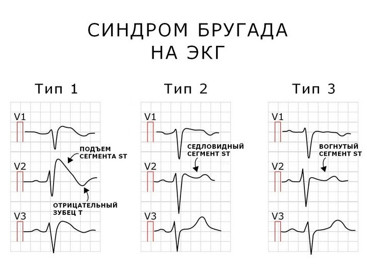 Один из вариантов каналопатий - синдром Бругада. Он легко выявляется с помощью обычной ЭКГ.