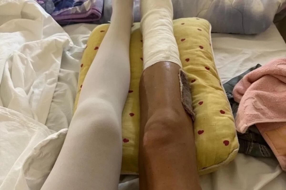    Жительнице Красноярска собрали сломанную в 12 местах ногу