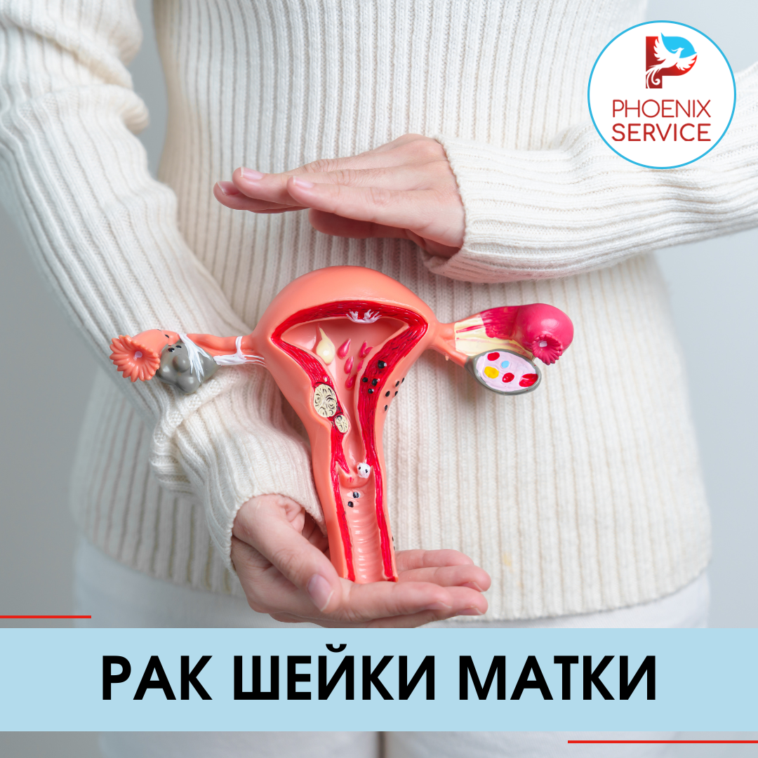 Рак шейки матки