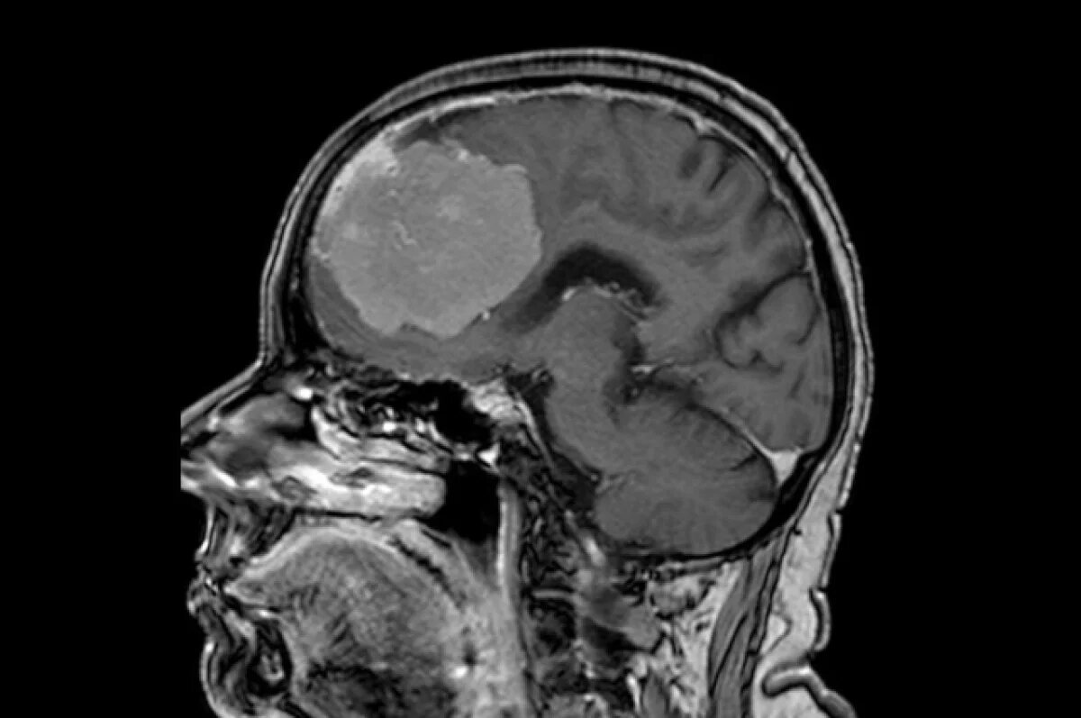    Опухоль размером с грейпфрут удалили из мозга 80-летней женщины в Воронеже