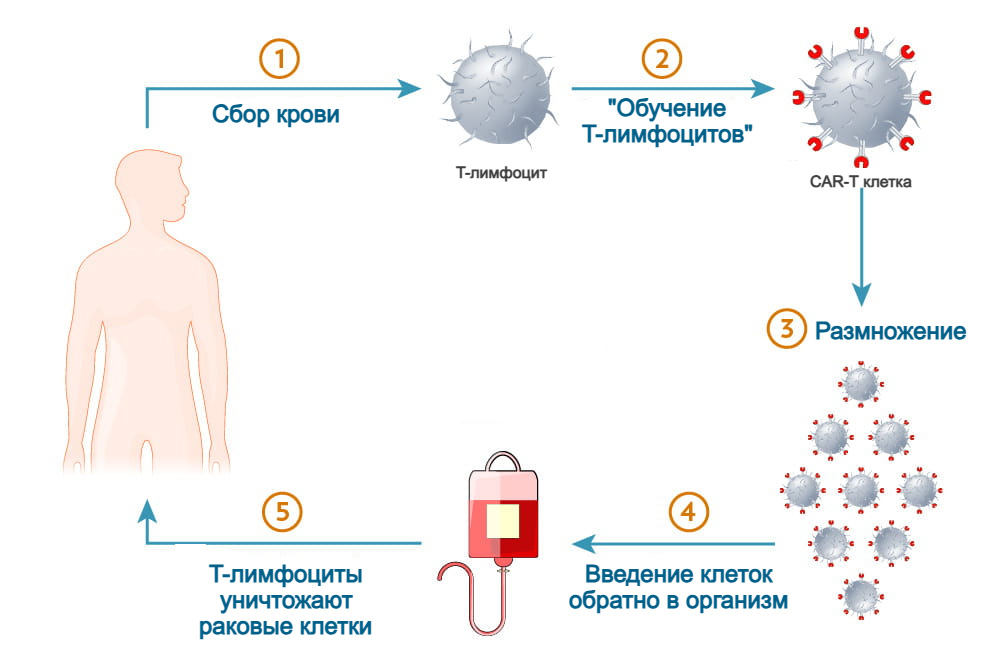 Так схематически выглядит клеточная терапия CAR-T. Источник: https://hollingscancercenter.musc.edu/patient-care/cancer-treatment/car-t-cell-therapy
