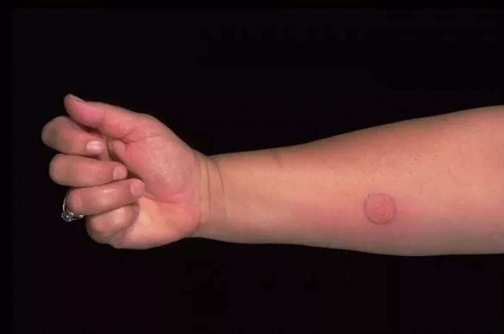 Кольцевидная эритрема